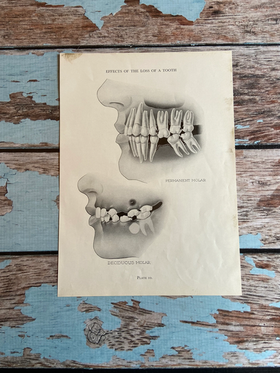 Vintage Teeth Mouth Medical Print. Black & White Lithograph To Frame. 1952. Effects Of Tooth Loss. Oral Cavity Oddity Dentist Surgeon